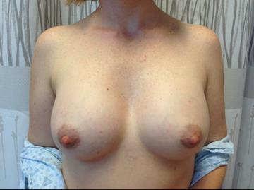 One Pt is a breast augmentation; another is bilateral