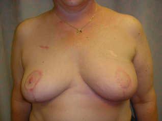 Nipple Breast
