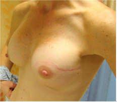 importance of adequate mastectomy Nipple Sparing
