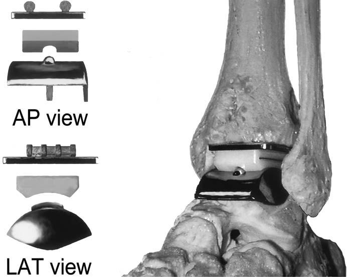 TOTAL ANKLE REPLACEMENT 335 Fig. 1 Photograph of the STAR prosthesis. Fig. 2 AP radiograph showing angular measurement of the preoperative deformity.