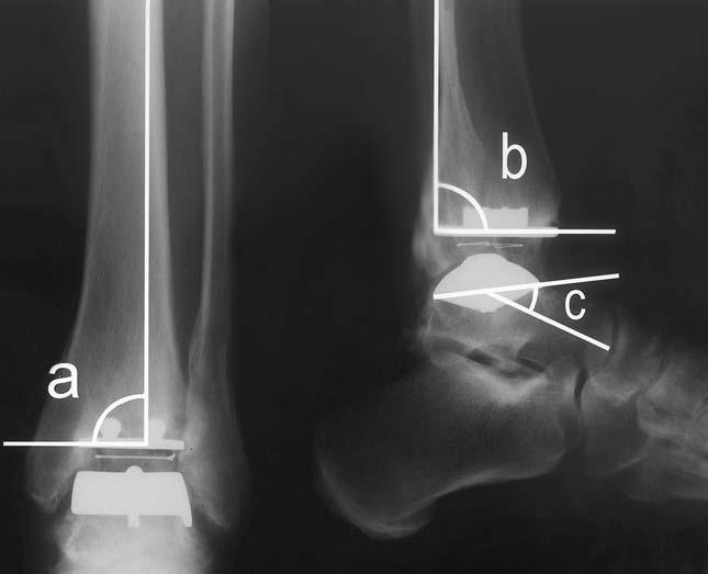 a is the angle between the anatomical axis of the tibia and the articular surface of the tibial implant, b is the angle between the anatomical axis of the