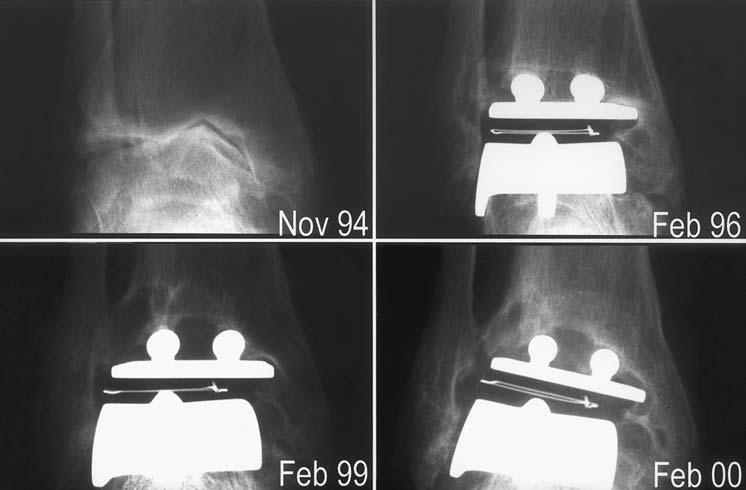 338 P. L. R. WOOD, S. DEAKIN Fig. 7 Radiographs showing the effect of cavitation in one patient. Table III.