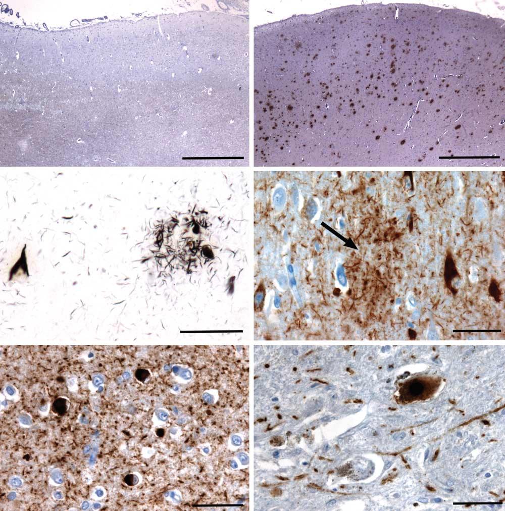 A B C D E F Figure 2. Neuropathological results for detection of amyloid, -synuclein, and tau aggregation.