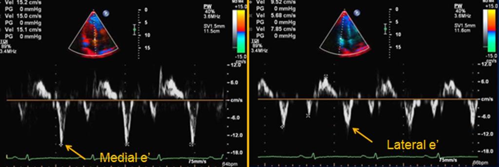 530 Circ Cardiovasc Imaging May 2014 Figure 3. Medial (left) and lateral (right) mitral annular tissue Doppler recording (apical window) in a patient with constrictive pericarditis.