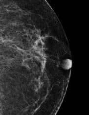 Benign Intraparenchymal Scarring in the DBT Era David Gruen, MD, MBA, FACR Director of Women s Imaging, Stamford Health, Stamford, CT With the advent of Digital Breast Tomosynthesis (DBT or 3D