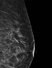 Case 2: CASE STUDY: 66 YEAR OLD PATIENT; 2015 Screening Mammogram