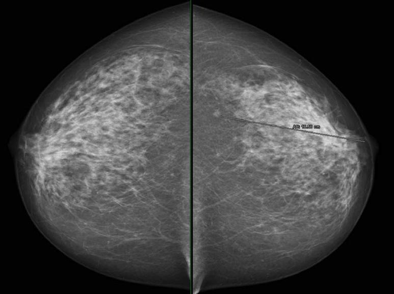 3D Automated Breast Ultrasound (ABUS): The dense breast screening tool and its potential role for preoperative staging Introduction Breast cancer is by far the most common cancer amongst women across