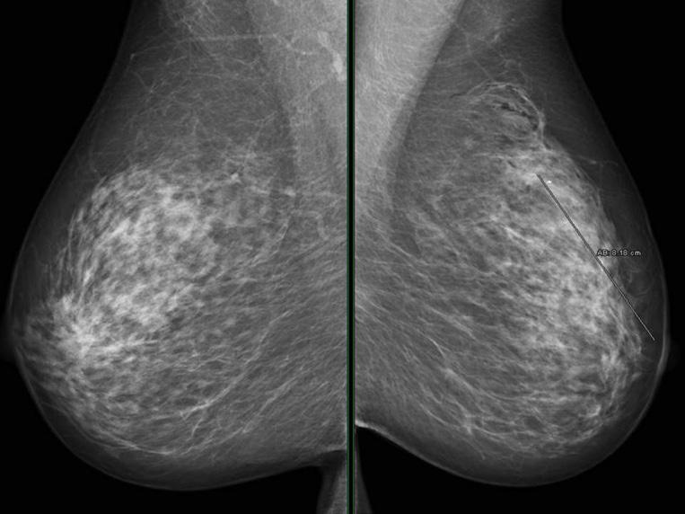 ² Case 1 Presentation 67 year old women was referred after a screening mammogram for further assessment. The mammogram demonstrated two lesions within 1.5 cm in the left upper outer quadrant.