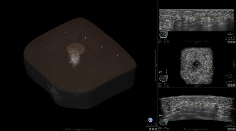 ultrasound reported and documented two lesions and no architectural distortion 3D ABUS demonstrated the same lesions visualized with handheld ultrasound, plus one additional lesion.