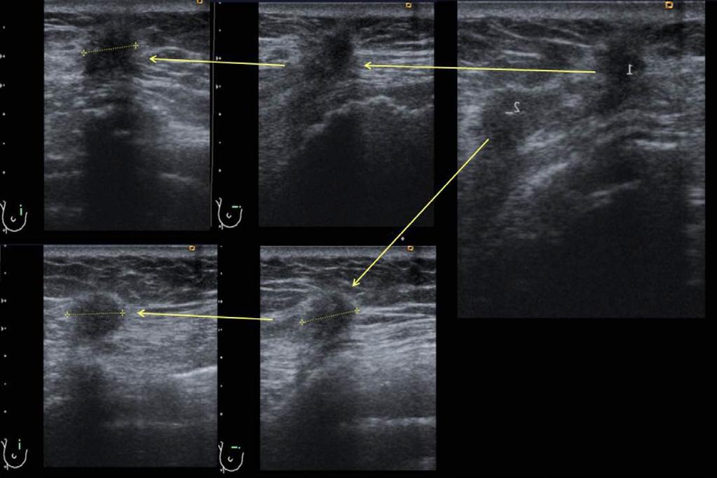any architectural distortion in the left breast Handheld ultrasound reported two hypoechoic irregular lesions with a maximum size of 12 mm.