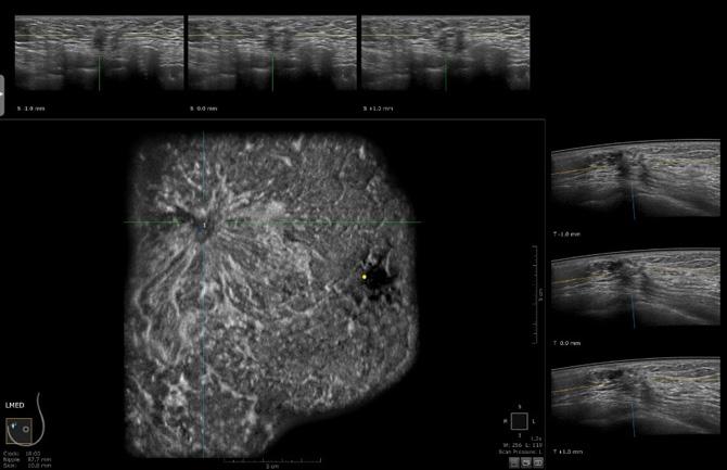 In contrast to handheld ultrasound, 3D ABUS reported only one coherent lesion with strong associated architectural distortions.