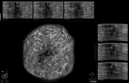 The coronal plane with multi-slice review precisely showed the suspicious lesion between 1-2 o clock in the lateral volume Handheld ultrasound clearly showed a 20 x 17 mm suspicious lesion