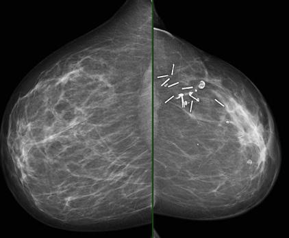 volume. Additionally, ABUS reported shadowing artifacts due to calcifications on the left side and due to fibrosis on the right side.
