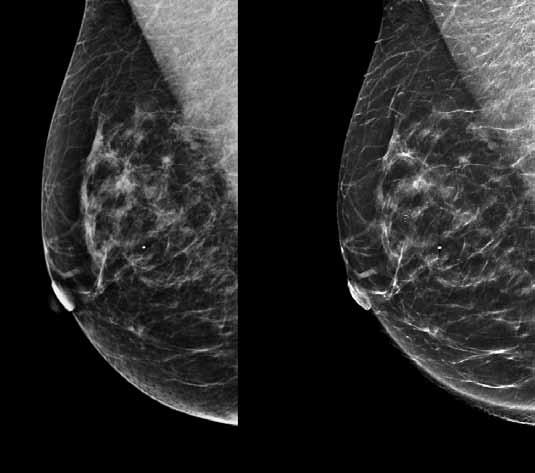 It is important to keep a perspective on the actual risks from the very low radiation doses delivered by modern mammography and tomosynthesis systems.