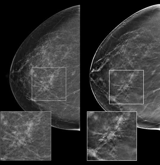 2D Tomo Rafferty studied the performance of tomosynthesis in women with dense breasts and found an increase in the recall for cancer cases and a reduction in the recall rate for non-cancer cases.