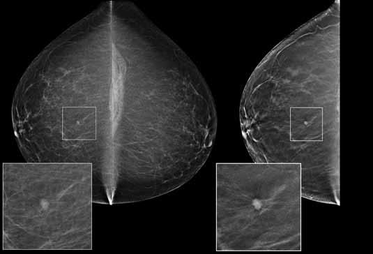 However, the even larger improvement in performance in denser breasts using tomosynthesis illustrates that tomosynthesis is doing what is expected from the physics principles reducing superimposed