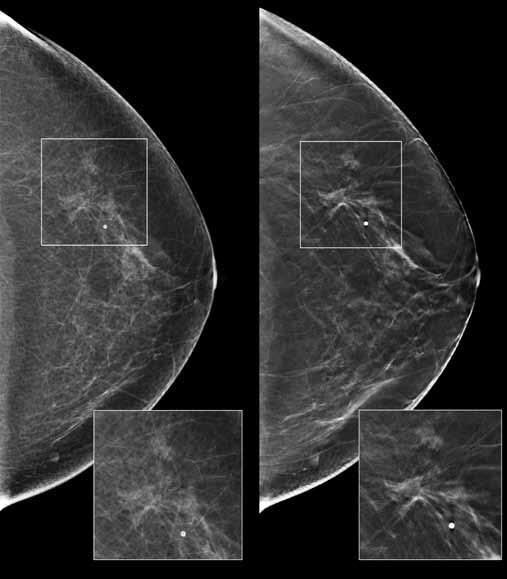 found comparable sensitivity and specificity in the use of two-view tomo imaging in place of the additional diagnostic 2D views typically taken.