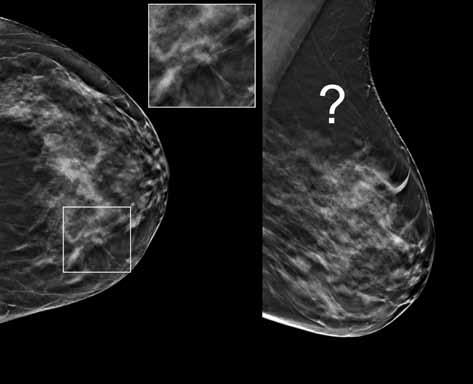 Clinical Considerations in Implementing Tomosynhesis Clinical research has shown the benefits of tomosynthesis in screening and diagnostic indications, as well as in a range of breast compositions