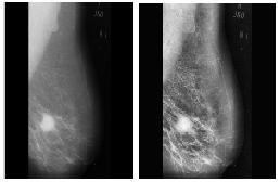 SHITAL LAHAMAGE, HARISHCHANDRA PATIL for mammograms using DWT proposed in [7].