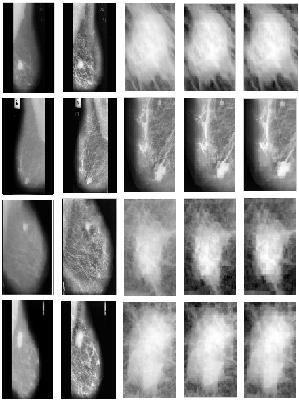 Breast Cancer Classification with Statistical Features of Wavelet Coefficient of Mammograms and the corresponding decision function in the original space can be non-linear.