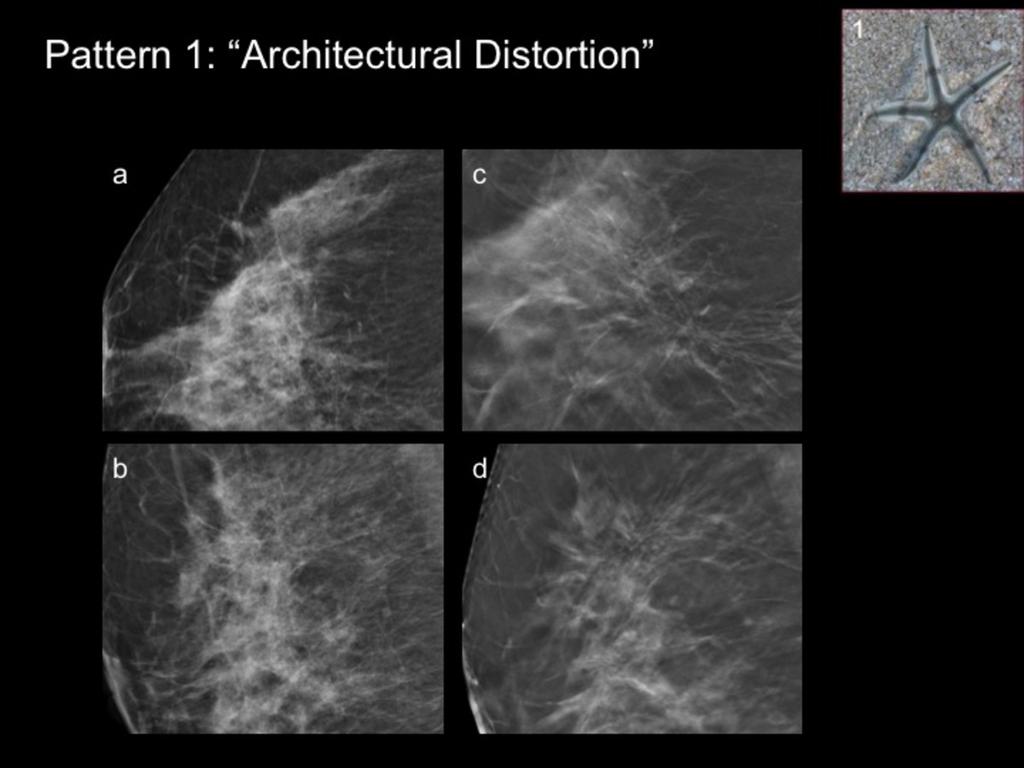 Fig. 6: Example of DBT pattern 1: "Architectural Distortion". 64 year-old woman, spontaneous screening. Mammogram reveals a heterogeneously dense breast tissue (BIRADS C).
