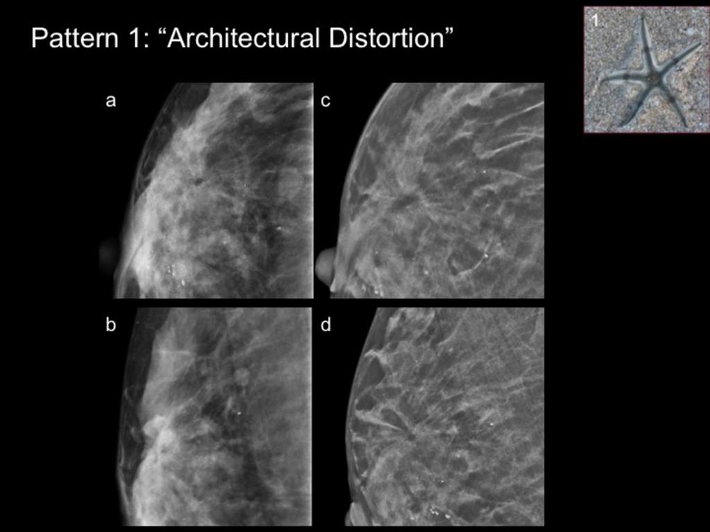 Fig. 8: Example of DBT pattern 1: "Architectural Distortion". 50 year-old woman undergoing her first screening mammography.