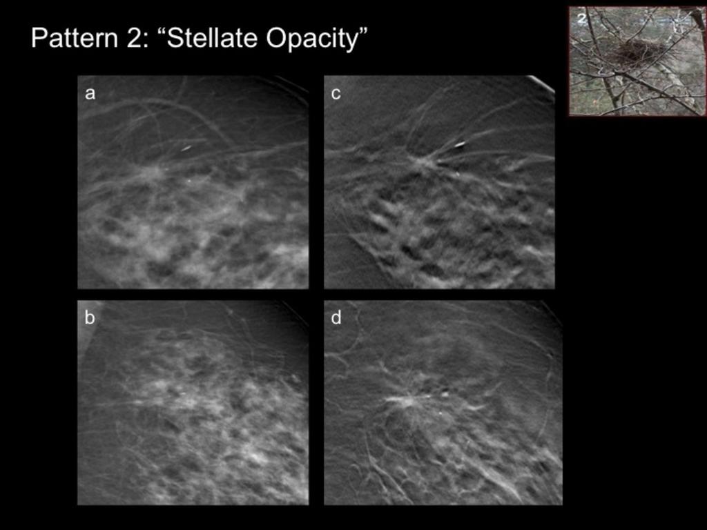 Fig. 10: Example of DBT pattern 2: "Stellate Opacity". 75 year-old woman, spontaneous screening.