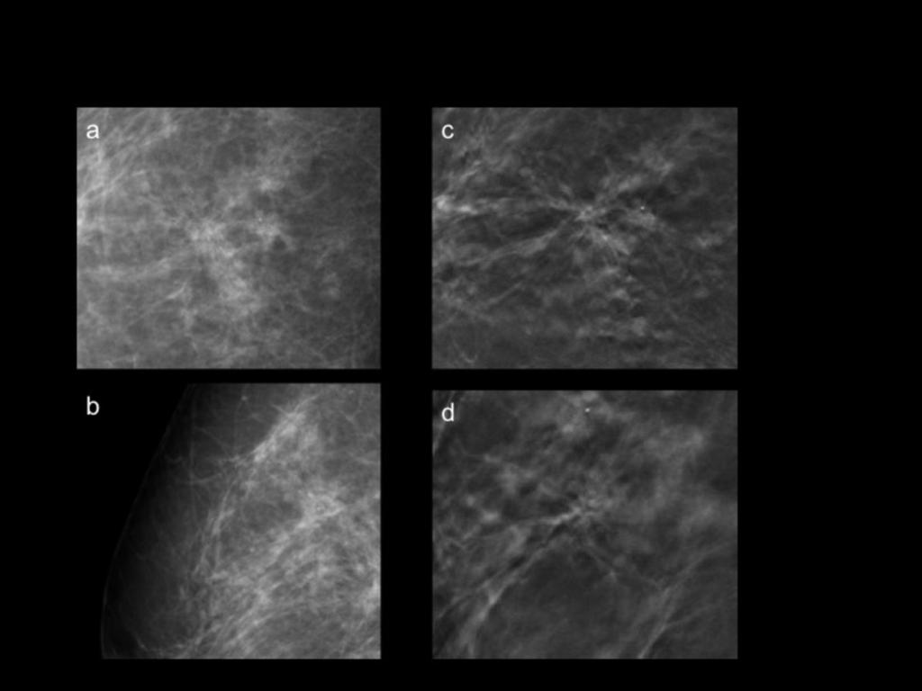 Fig. 3: 50 year-old woman, callback after a screening mammogram (first examination).