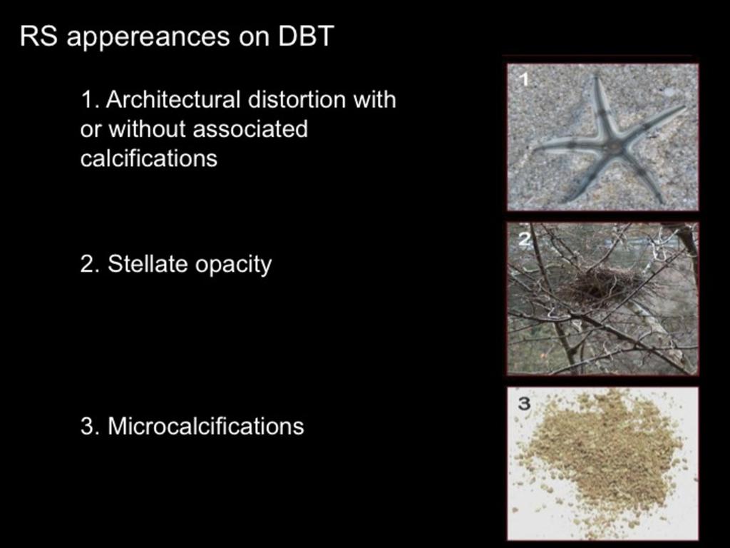Fig. 5: Patterns of DBT presentation of radial scar. Linda A. et al.