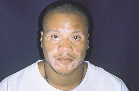 J AM ACAD DERMATOL VOLUME 44, NUMBER 6 Scherschun, Kim, and Lim 1001 A B C Fig 1. A, Pretreatment photograph of a 25-year-old African American man with a 3-year history of vitiligo.