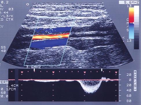 Zierler Diagosing VTE I-11 Figure 1. Color Doppler image of normal calf veins (posterior tibial). The paired posterior tibial veins (blue) are located on each side of the posterior tibial artery.