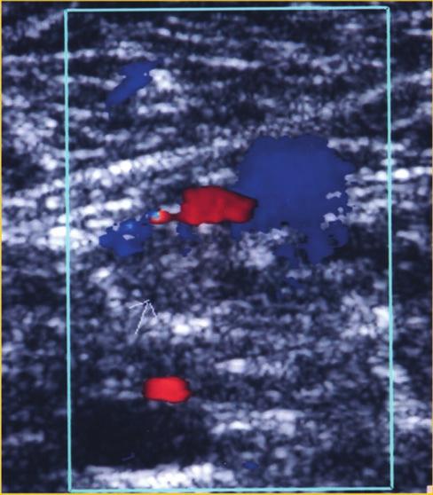 Serial duplex scans are, however, indicated for patients who present with symptoms of possible DVT and have a negative venous ultrasound examination that has been limited to the proximal veins and in