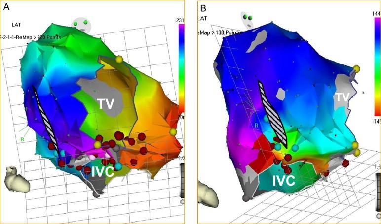 Figure 2. Electroanatomic maps of the right atrium demonstrating atrial macroreentry that developed in an adult with tetralogy of Fallot many years after surgical repair.