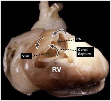 Figure 1. Pathologic specimen from a young patient with unrepaired tetralogy of Fallot demonstrating the intrinsic anatomic features that can contribute to macroreentrant ventricular tachycardia.