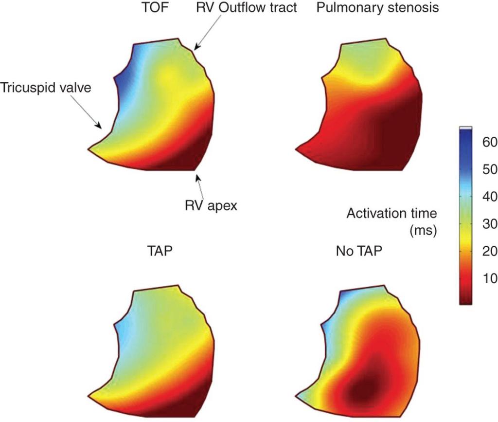 Simple colour map representation of average activation patterns across the RV in both ToF and congenital PS, with and without TAP repair.