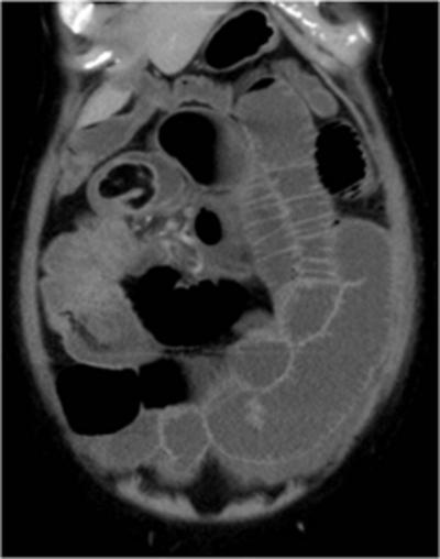 Figure 2 Figure 2: CT coronal view showing a fat-attenuation lesion at the lead point of intussusceptum Figure 3 Figure 3: CT sagittal view showing