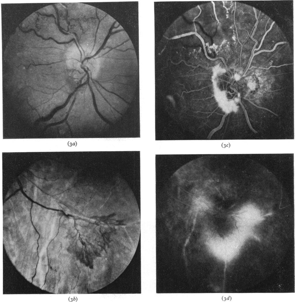 8I2 British Yournal of Ophthalmology (3a) (3c) Br J Ophthalmol: first published as 10.1136/bjo.60.12.810 on 1 December 1976. Downloaded from http://bjo.bmj.com/ (3b) FIG.