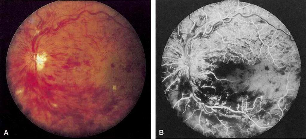 Fluorescein Angiography in CRVO