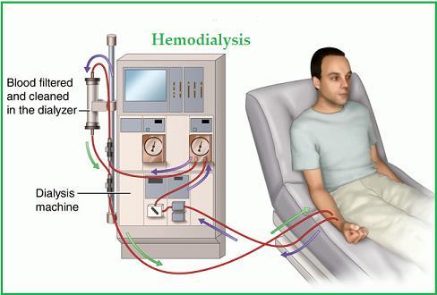 What Is Hemodialysis? Hemodialysis is a type of dialysis where a machine takes over the job of your kidneys and filters and cleanses your blood artificially.