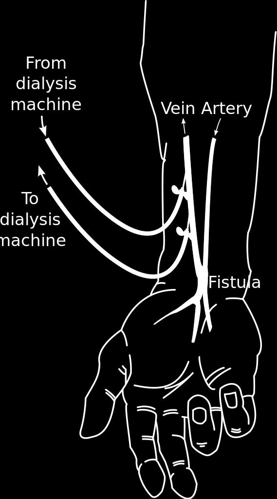 machine. Blood is removed from your body through one needle, and returned to your body through the other. An AV fistula is usually created many weeks to months before it is used for dialysis.