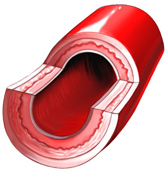 What is atherosclerosis? Atherosclerosis is a disease affecting the arteries. Abnormal fatty material (called atheroma) coats the inside of an artery, causing it to narrow or harden (see figure 1).