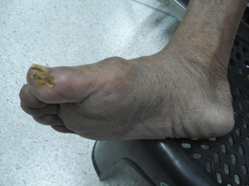 A 72-year-old male presents with ischemic ulcer on his right 1 st toe for