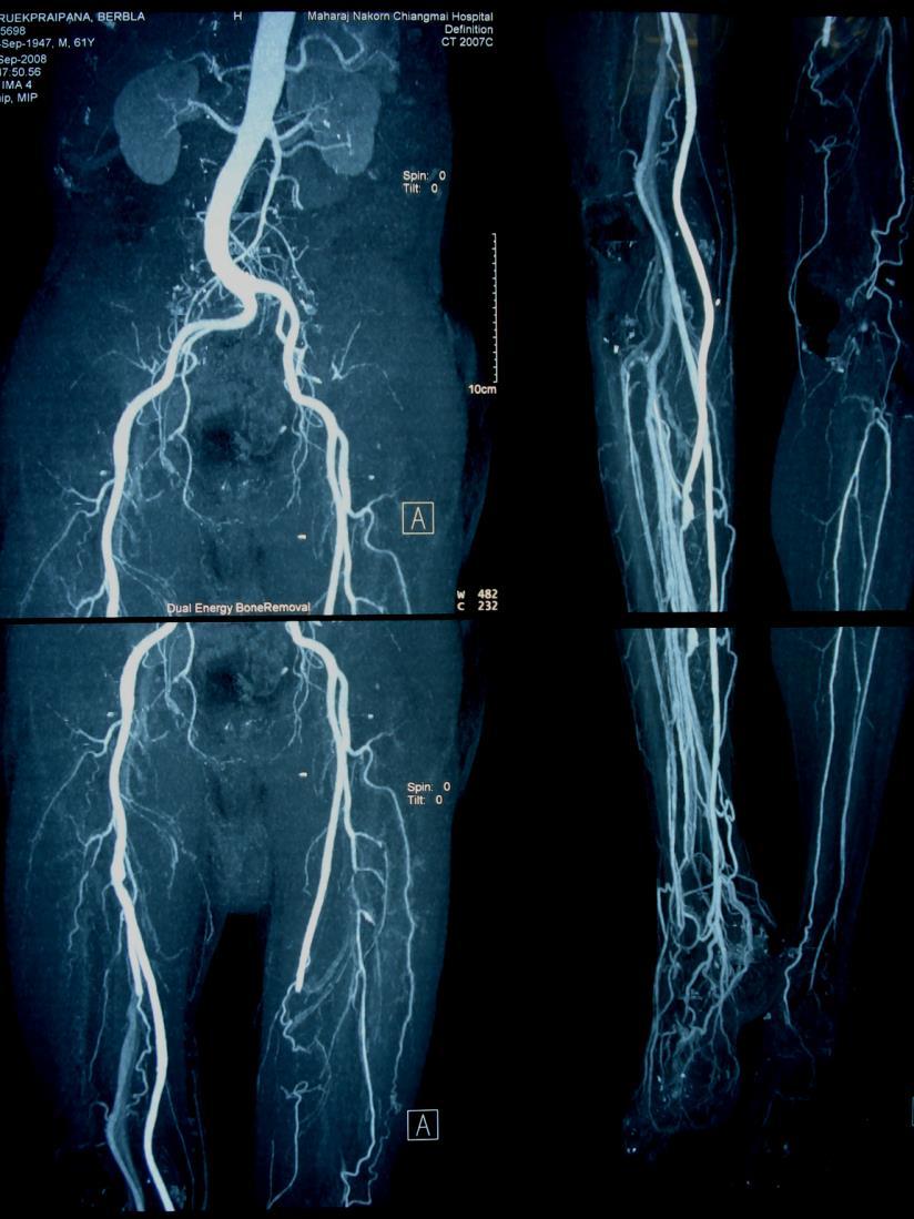 Femeral-Posterior Tibial Artery Bypass
