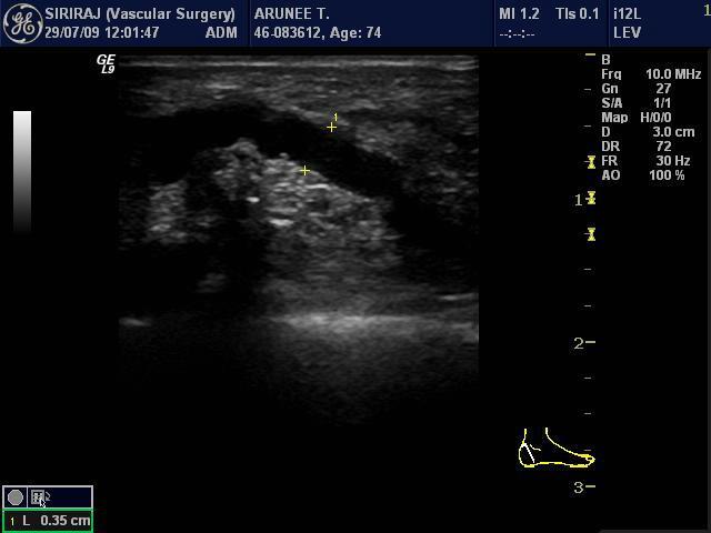 Duplex ultrasonography: assessment of