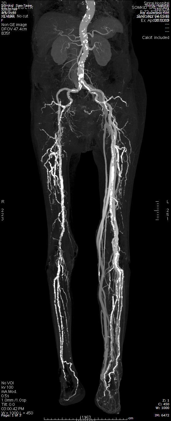 posterior tibial
