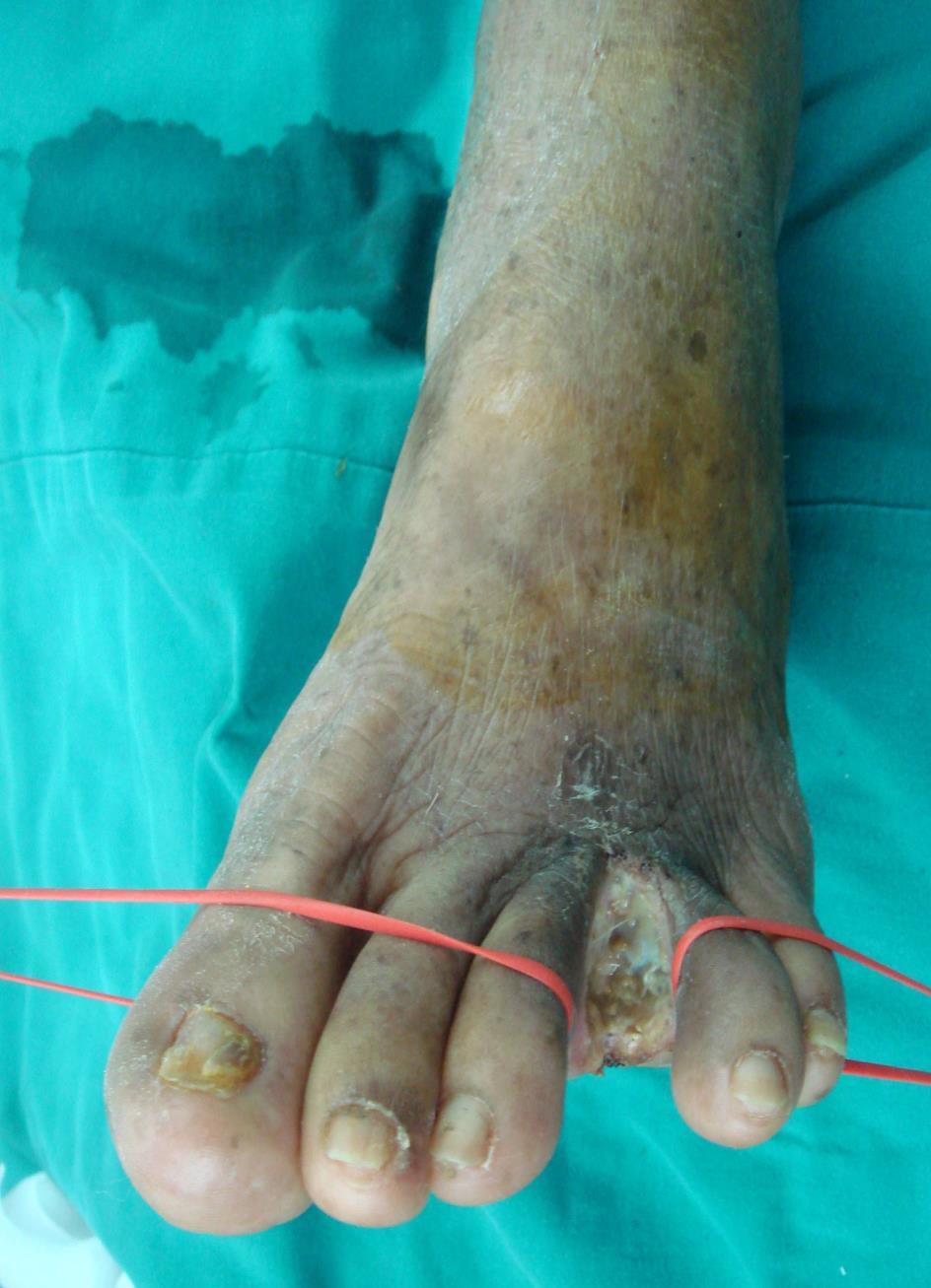 Critical limb ischemia Ankle pressure =
