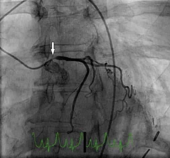 Back to Case 60 year old female, radiotherapy 8 years earlier and in remission CABG or PCI?