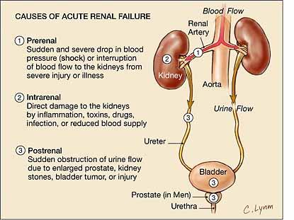 All kidney disease can be classified according to this scheme 50% Pre-renal