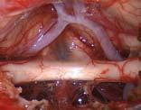 a.m. Live surgery: Endonasal endoscopic skullbase surgery and