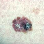 Superficial spreading melanomas Melanomas which are